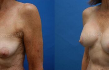 Breast Augmentation And Mastopexy Before and After | Sayah Institute