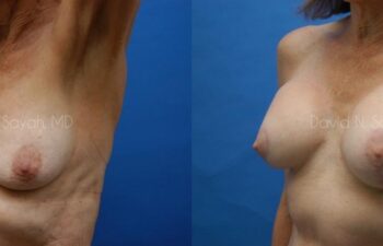 Breast Augmentation And Mastopexy Before and After | Sayah Institute