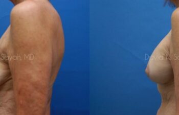 Breast Augmentation And Mastopexy Before and After | Sayah Institute