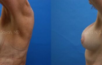 Breast Augmentation And Mastopexy Before and After | Sayah Institute