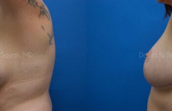 Breast Reduction Before and After | Sayah Institute