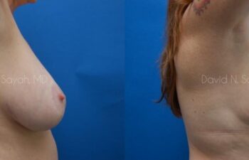 Breast Reduction Before and After | Sayah Institute
