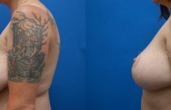 Breast Reduction Before and After | Sayah Institute