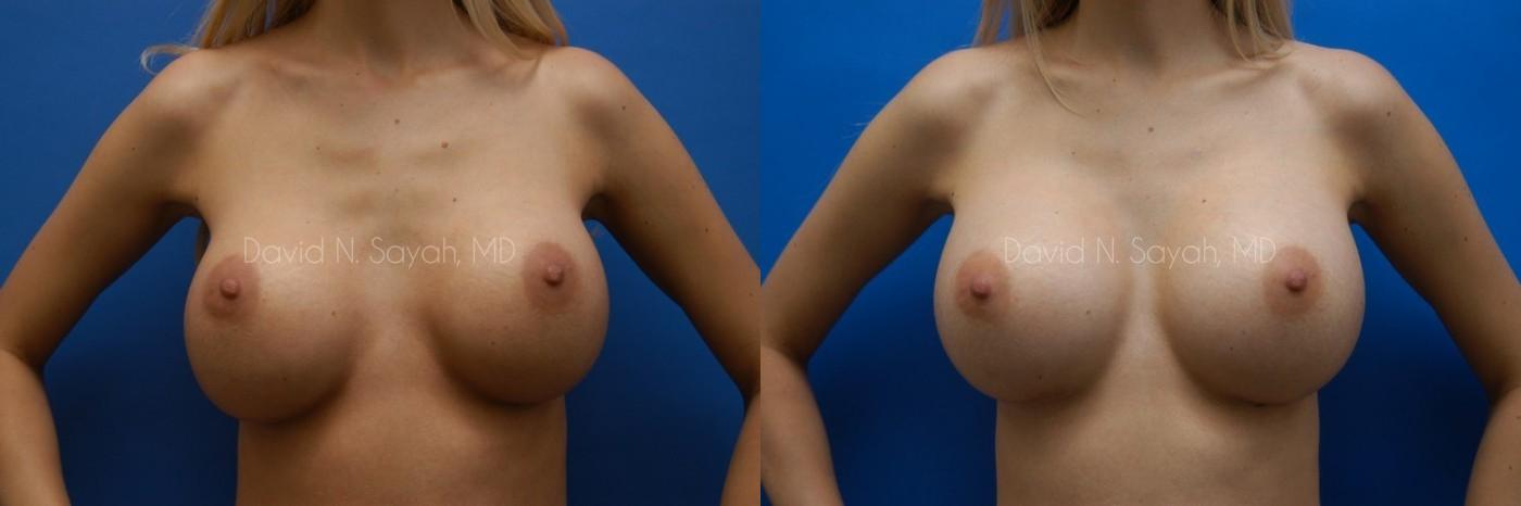 Breast Augmentation Before and After | Sayah Institute