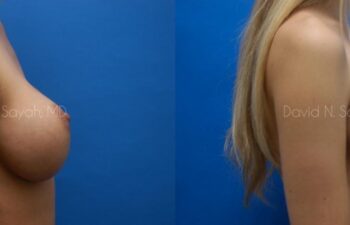 Breast Augmentation Before and After | Sayah Institute