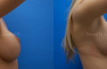 Breast Augmentation Before and After | Sayah Institute