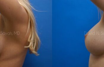 Breast Augmentation Before and After | Sayah Institute