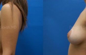 Breast Implant Removal Before and After | Sayah Institute