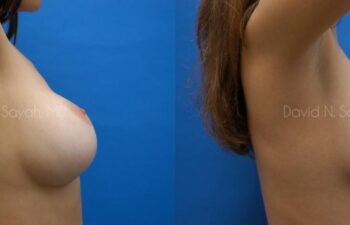 Breast Implant Removal Before and After | Sayah Institute