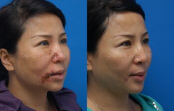 Scar Revision Face Before and After | Sayah Institute