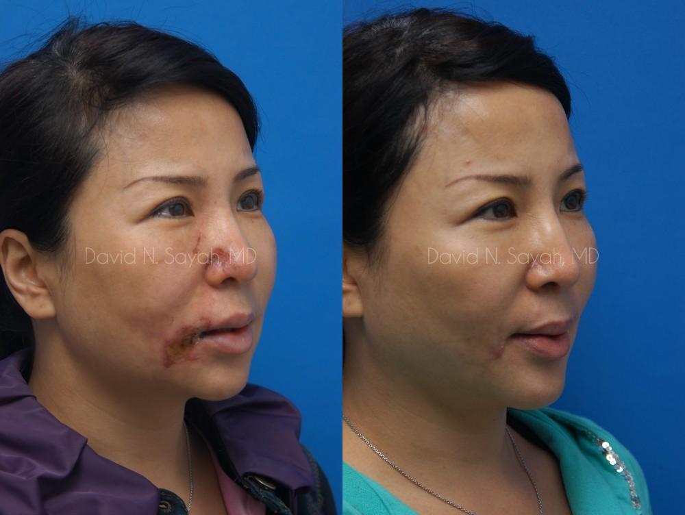 Scar Revision Face Before and After | Sayah Institute