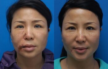 Scar Revision Face Before and After | Sayah Institute