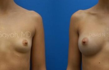 Breast Augmentation Before and After | Sayah Institute