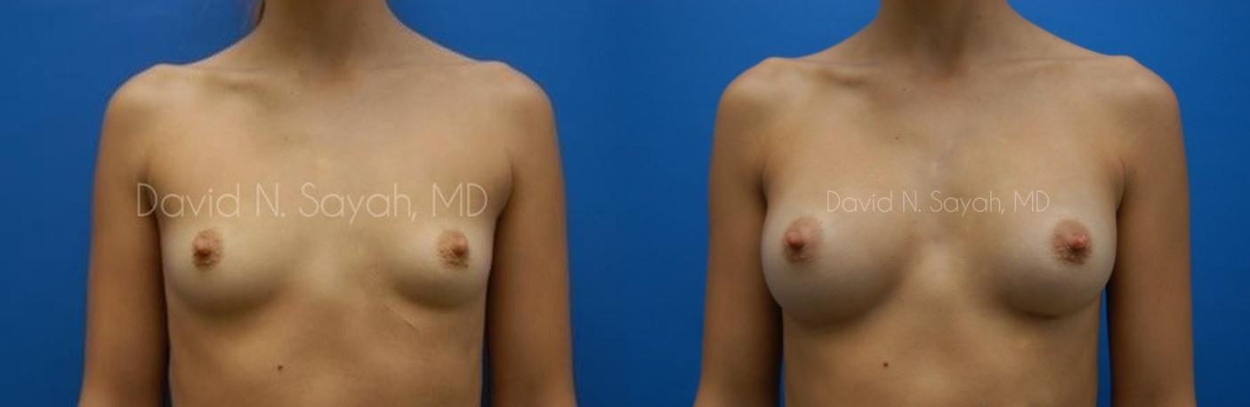 Breast Augmentation Before and After | Sayah Institute