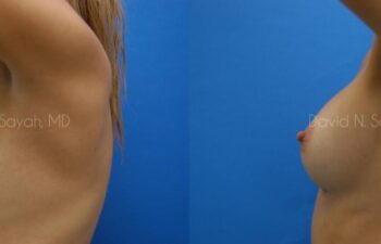 Breast Augmentation Before and After | Sayah Institute