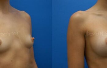 Breast Augmentation Before and After | Sayah Institute