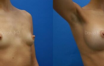 Breast Augmentation Before and After | Sayah Institute