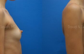 Breast Augmentation Before and After | Sayah Institute
