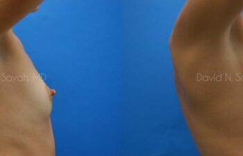Breast Augmentation Before and After | Sayah Institute