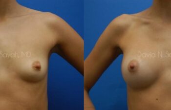 Breast Augmentation Before and After | Sayah Institute