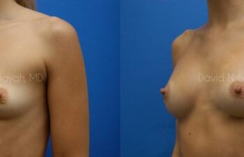 Breast Augmentation Before and After | Sayah Institute