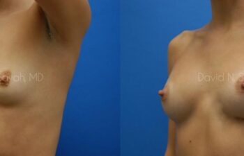 Breast Augmentation Before and After | Sayah Institute
