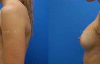 Breast Augmentation Before and After | Sayah Institute