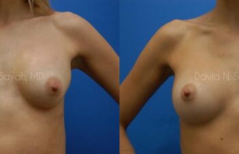 Breast Implant Revision Before and After | Sayah Institute