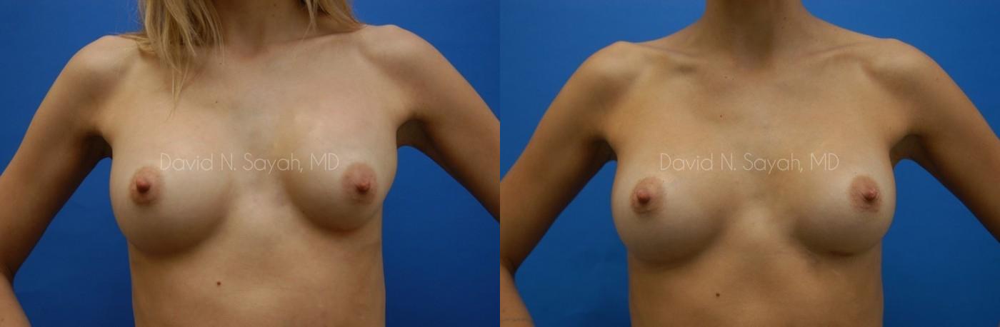 Breast Implant Revision Before and After | Sayah Institute