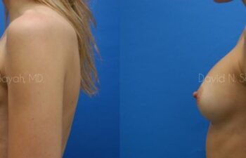 Breast Implant Revision Before and After | Sayah Institute