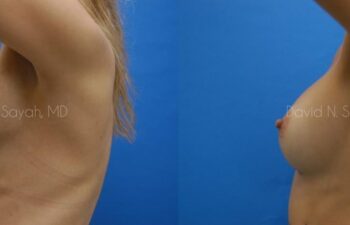 Breast Implant Revision Before and After | Sayah Institute