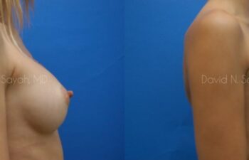 Breast Implant Revision Before and After | Sayah Institute