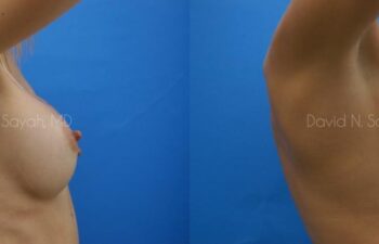 Breast Implant Revision Before and After | Sayah Institute
