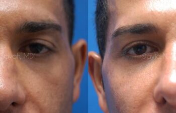 Eyelid Surgery Before and After | Sayah Institute