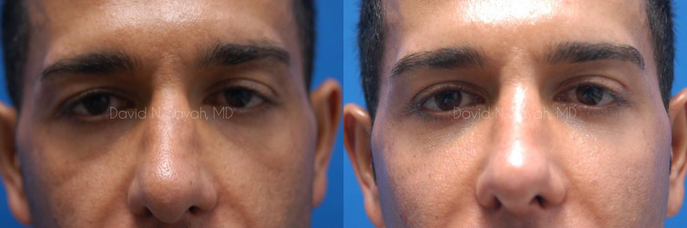 Eyelid Surgery Before and After | Sayah Institute