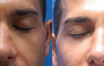 Eyelid Surgery Before and After | Sayah Institute