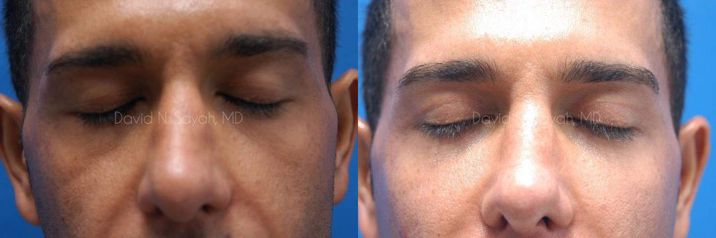 Eyelid Surgery Before and After | Sayah Institute
