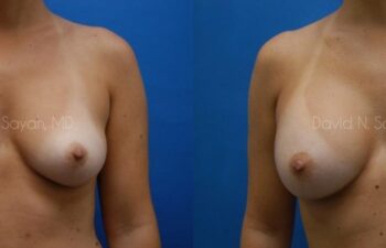Breast Augmentation Before and After | Sayah Institute