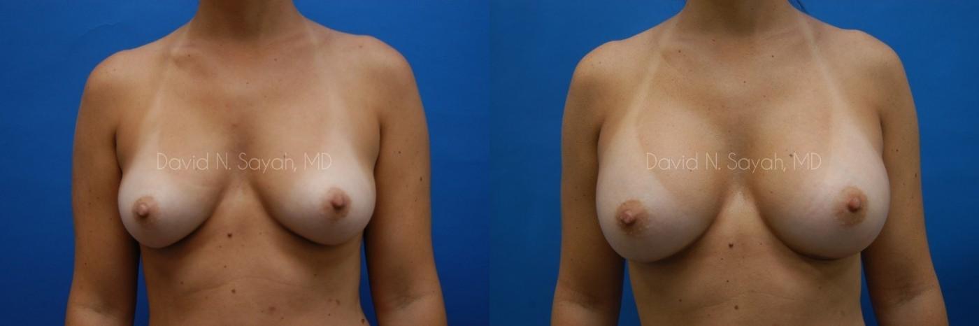 Breast Augmentation Before and After | Sayah Institute