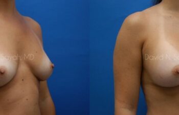 Breast Augmentation Before and After | Sayah Institute