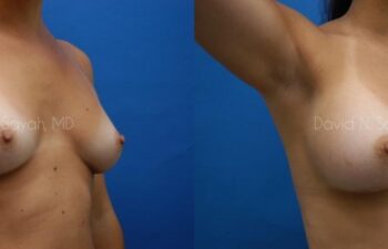 Breast Augmentation Before and After | Sayah Institute
