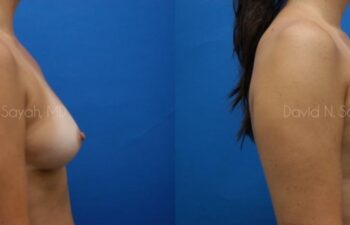 Breast Augmentation Before and After | Sayah Institute