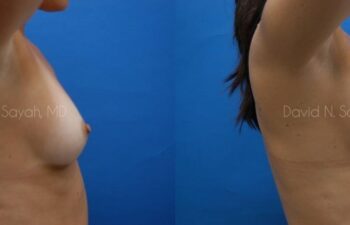 Breast Augmentation Before and After | Sayah Institute