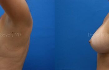 Breast Augmentation Before and After | Sayah Institute