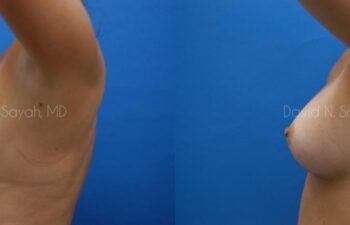 Breast Augmentation Before and After | Sayah Institute