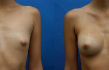 Breast Augmentation Before and After | Sayah Institute