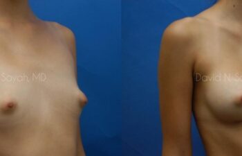 Breast Augmentation Before and After | Sayah Institute