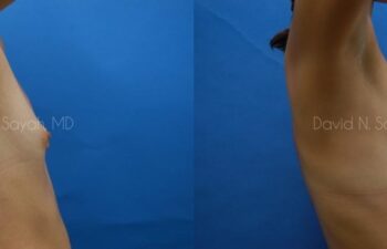 Breast Augmentation Before and After | Sayah Institute