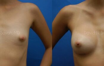 Breast Augmentation Before and After | Sayah Institute