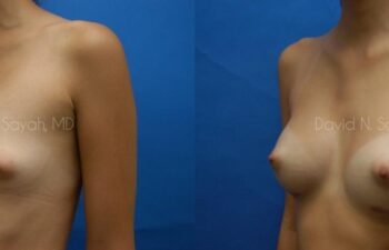 Breast Augmentation Before and After | Sayah Institute